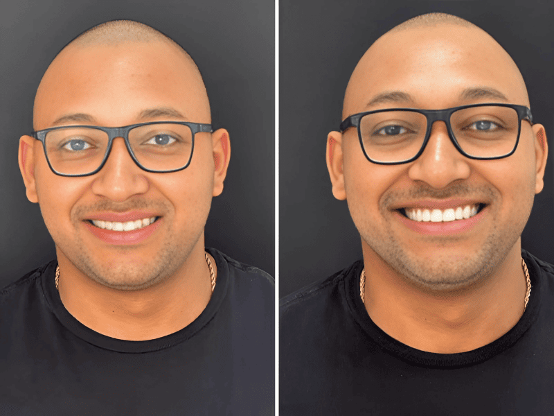 Facetas De Porcelana