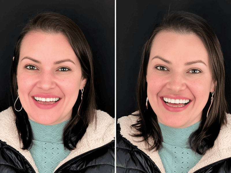 Facetas de Resina